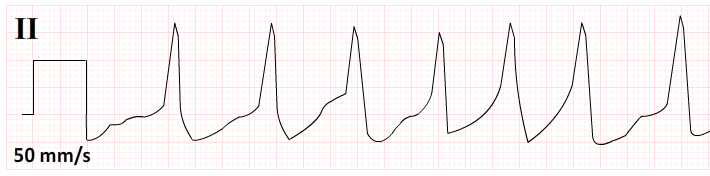 afib