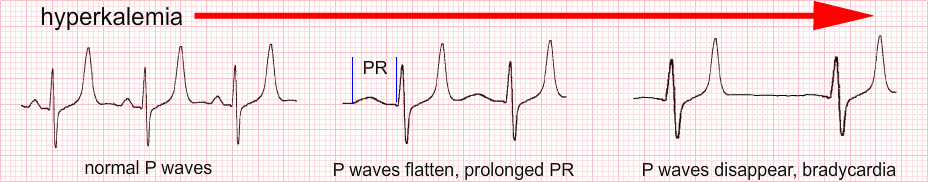 hyperkalemia2