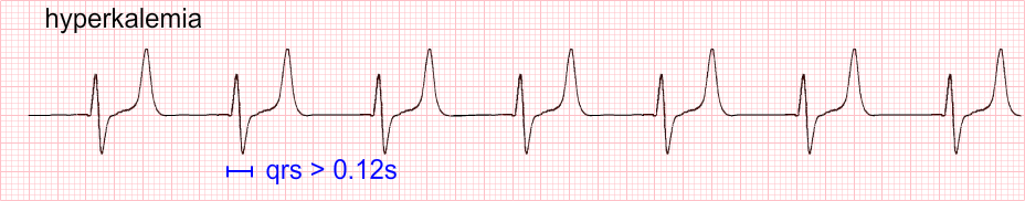 hyperkalemia3