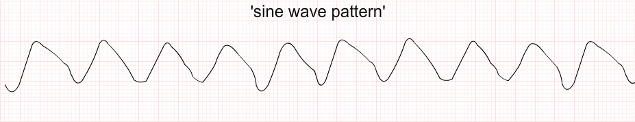 hyperkalemia4